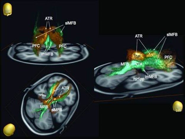 diffusion tensor imaging picture of the SEEKING pathway